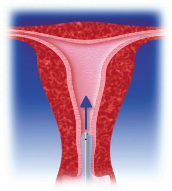 Insertion of a Cavaterm catheter into the uterine cavity