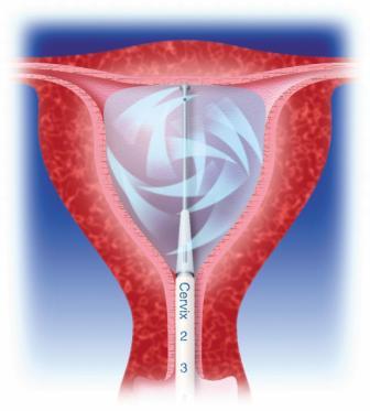 Balloon catheter inside uterine cavity during a treatment (heating and circulation)