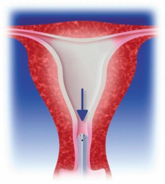 Removal of a Cavaterm catheter from uterine cavity